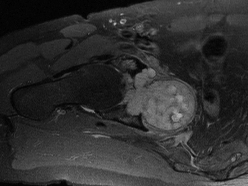 Fig 3. Axial MRI showing tumour